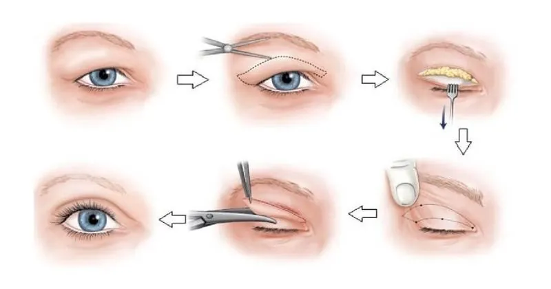 Kỹ thuật Cắt mí Plasma đình đám, duy trì nếp mí ổn định lâu năm