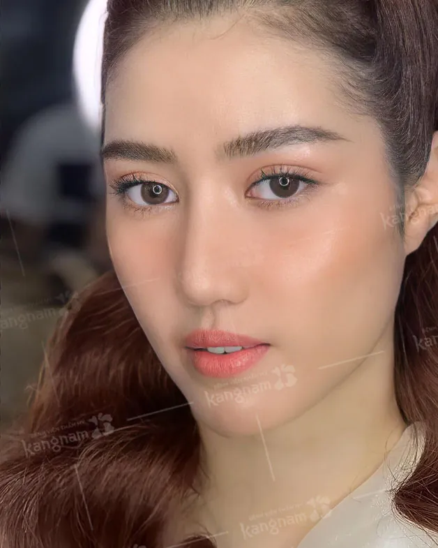 Địa chỉ cắt mí ở Nghệ An