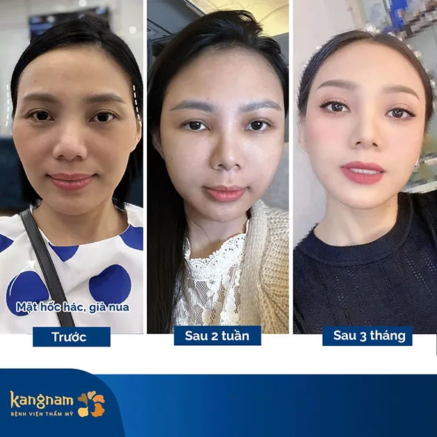 Kết quả sau 3 tháng thực hiện độn thái dương tại Kangnam, khuôn mặt khách hàng đầy đặn, không còn hốc hác như trước