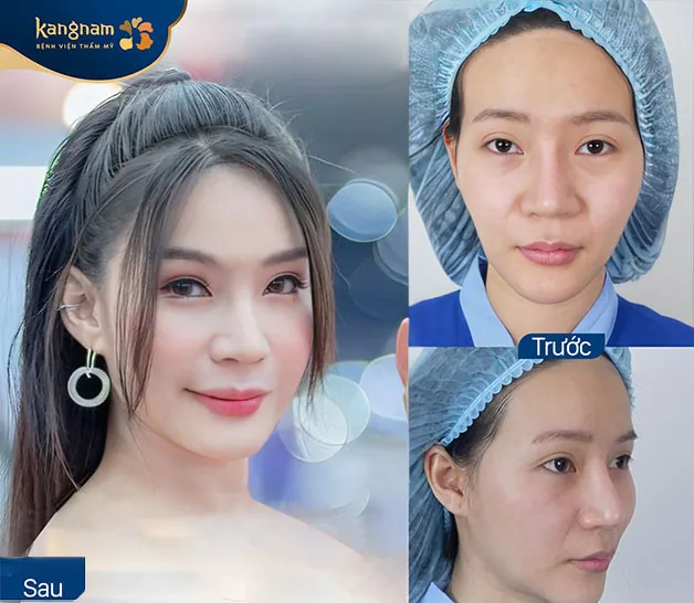 Hai bên thái dương đối xứng, khuôn mặt cân đối và tự nhiên hơn nhiều