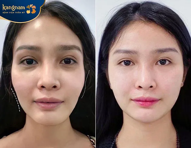 Chị Mai Hồng chia sẻ: "Sau khi thực hiện độn thái dương tại Kangnam, mình cảm thấy như trẻ ra chục tuổi. Mặt đầy đặn hơn cũng tự tin với diện mạo mới của mình".