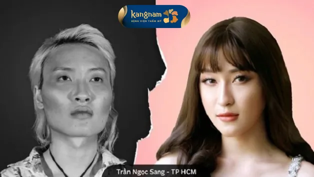 Bạn Trần Ngọc Sang cảm thấy may mắn khi chọn Kangnam phẫu thuật thẩm mỹ