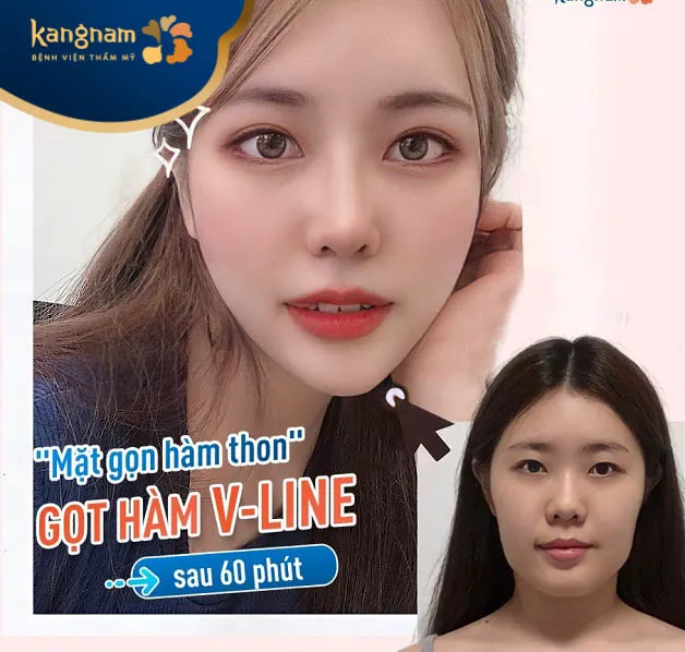 Gọt hàm Vline 6D