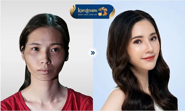 Hình ảnh khách hàng sau khi phẫu thuật