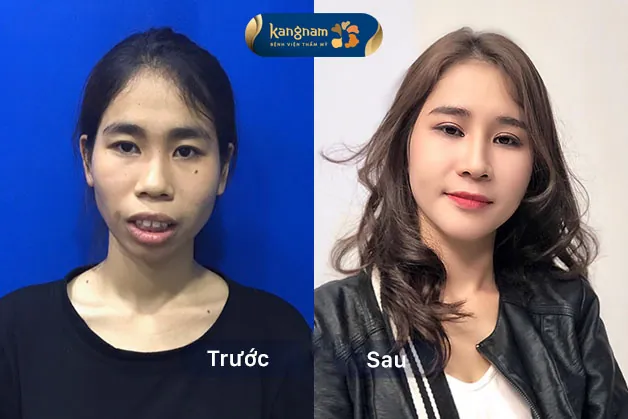 Khuôn mặt trở lên thanh thoát, xinh đẹp hơn sau khi thực hiện cùng lúc 2 dịch vụ hạ gò má và cắt hàm hô 