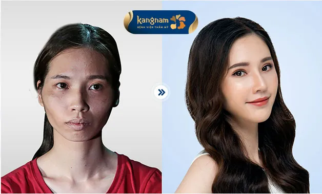 Tại Kangnam có đội ngũ bác sĩ chuyên môn, ứng dụng công nghệ hiện đại đã giúp nhiều khách hàng lột xác hoàn toàn 