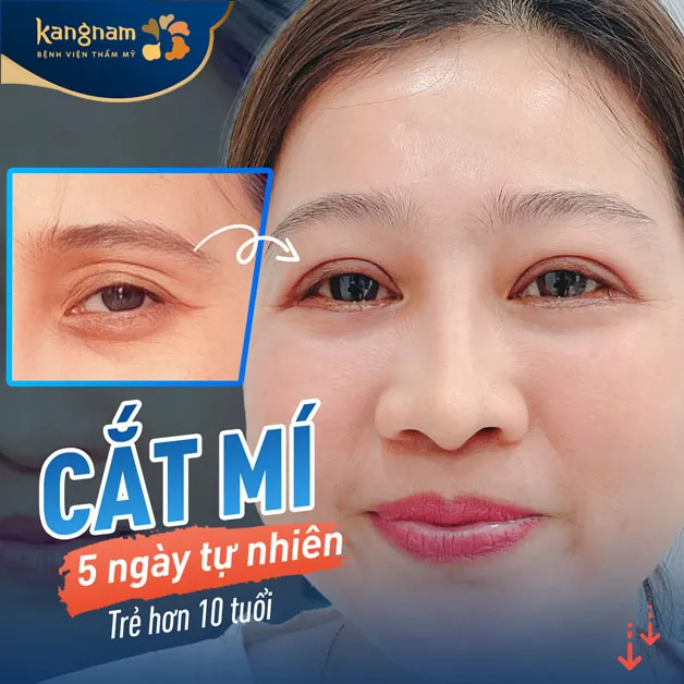 Hình ảnh khách hàng cắt mí sau 5 ngày siêu tự nhiên