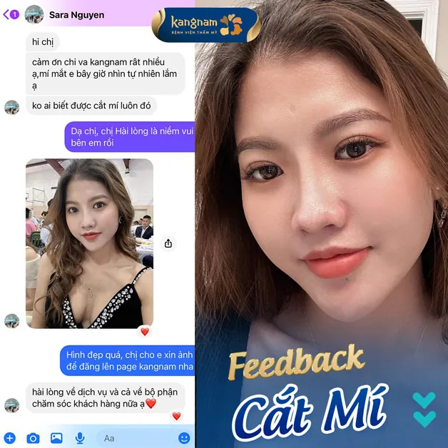 Sara Nguyễn sở hữu mí mắt cân đối, tự nhiên sau khi cắt mí tại Kangnam