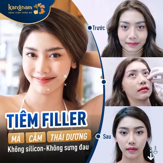 Tiêm filler làm đầy thái dương