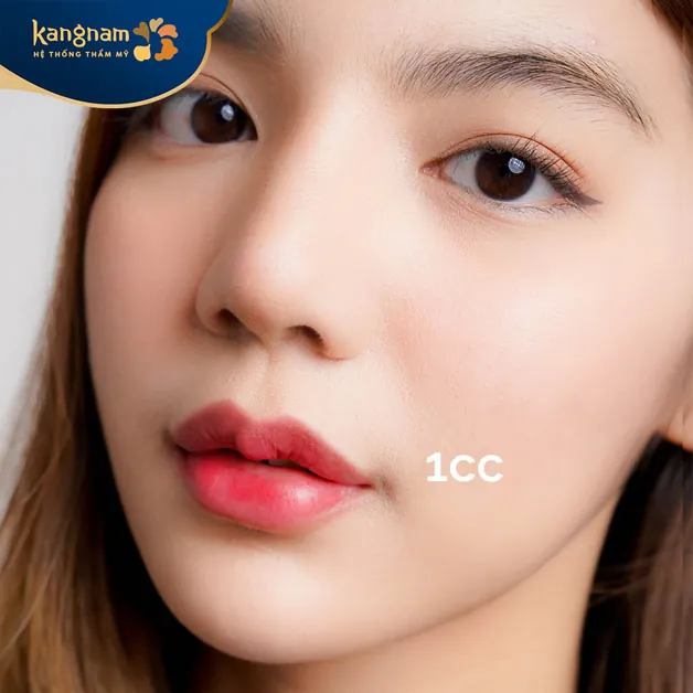 Kết quả tiêm filler đẹp tự nhiên