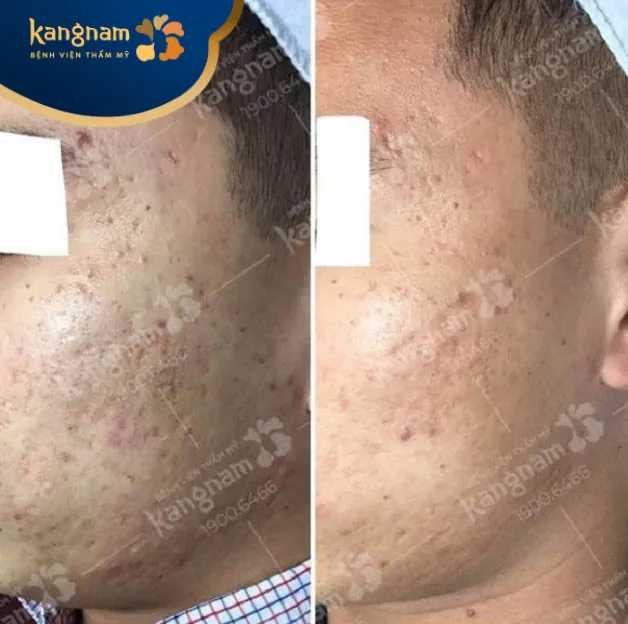 Trị sẹo lõm rỗ tại Kangnam Thanh Hóa