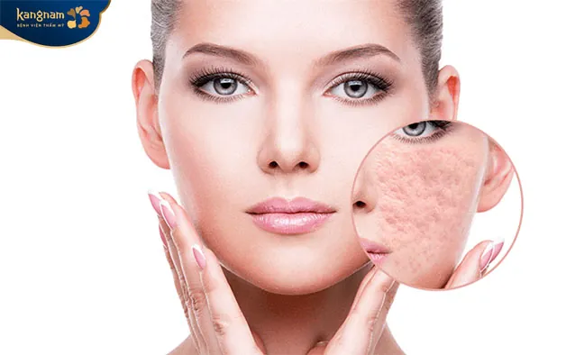 Bóc tách sẹo rỗ giúp cải thiện làm da bằng phẳng, mịn màng 