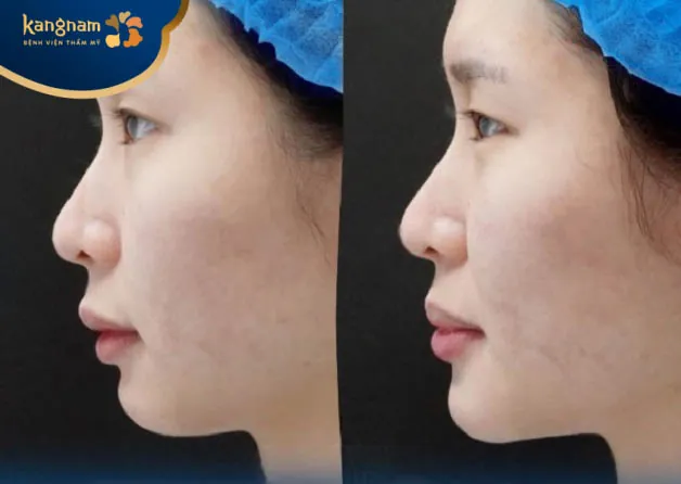 Độn cằm Hàn Quốc (chất liệu thông thường)