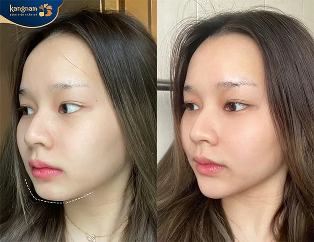 Hình ảnh khách hàng gửi đến Kangnam sau 1 tháng độn cằm 