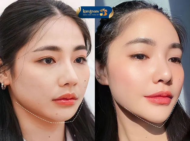 Cằm chuẩn Vline hài hòa với các đường nét trên gương mặt 
