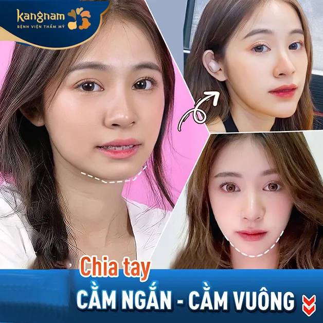 Các công nghệ độn cằm hiện đại mang đến dáng cằm Vline theo đúng xu hướng hiện đại 