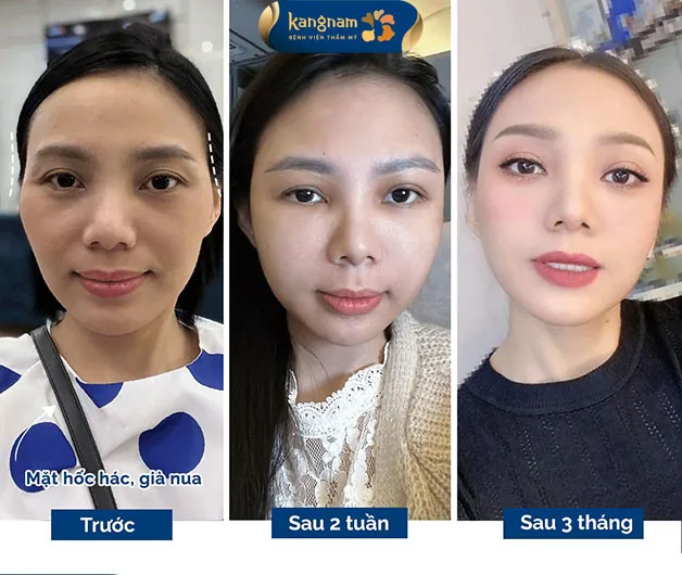 Gương mặt không còn hốc hác sau 3 tháng thực hiện 