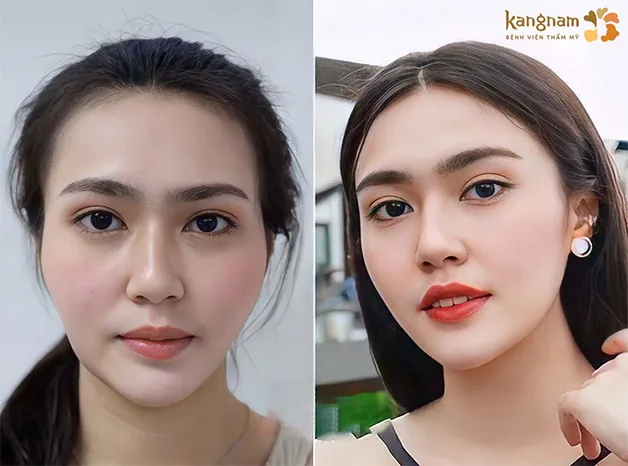 Khuôn mặt khách hàng trẻ trung hơn sau khi thực hiện độn thái dương 