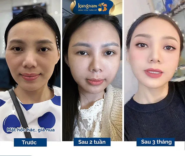 Khách hàng như được trẻ ra 10 tuổi sau khi độn thái dương tại Kangnam 