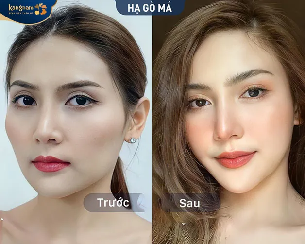 Viện thẩm mỹ Kangnam Bình Dương địa chỉ hạ gò má chất lượng, chuẩn y khoa