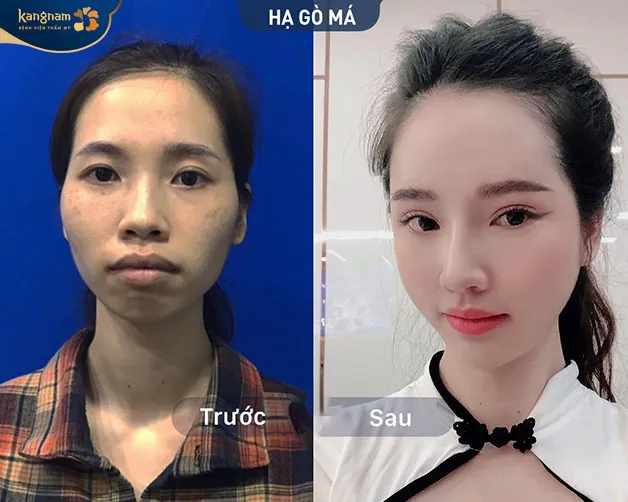 Viện thẩm mỹ Kangnam Cần Thơ địa chỉ hạ gò má chất lượng, chuẩn y khoa