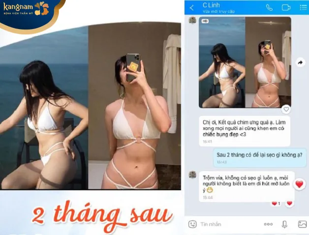 Chị Linh gửi ảnh mặc bikini khoe dáng sau hút mỡ 2 tháng