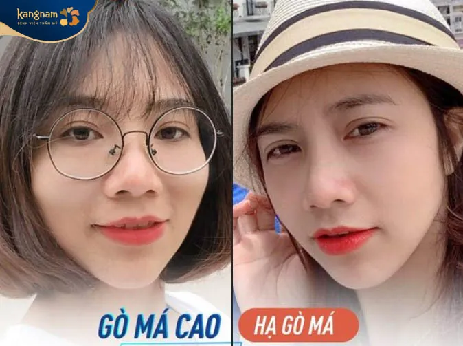 Khách hàng Lan Hương thay đổi ngoạn mục sau khi hạ gò má 