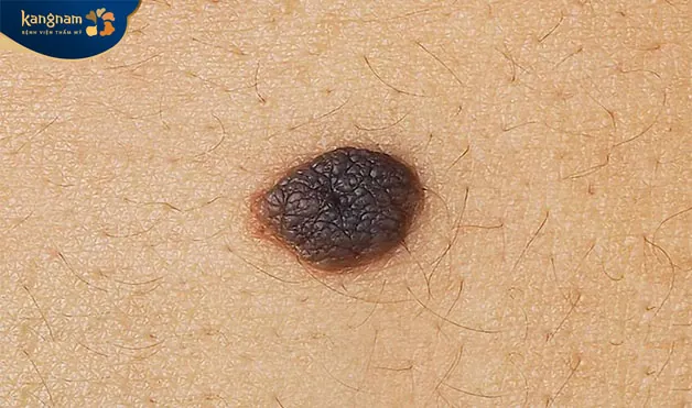 Nốt ruồi có điều khác biệt như sưng to hoặc đau đớn thì nên xóa 