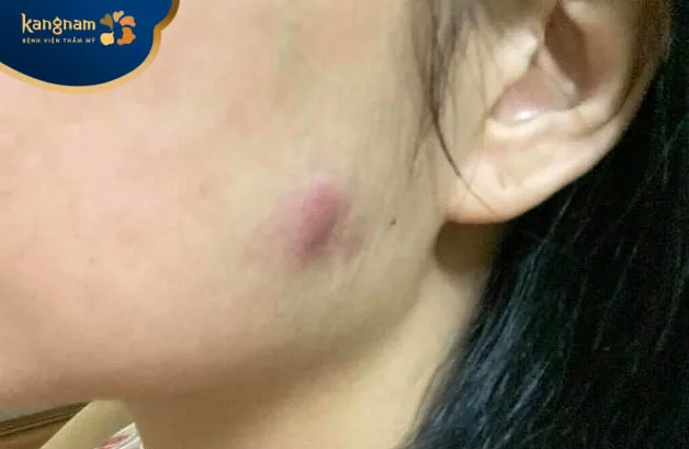 Ổ áp xe xuất hiện sau tiêm botox