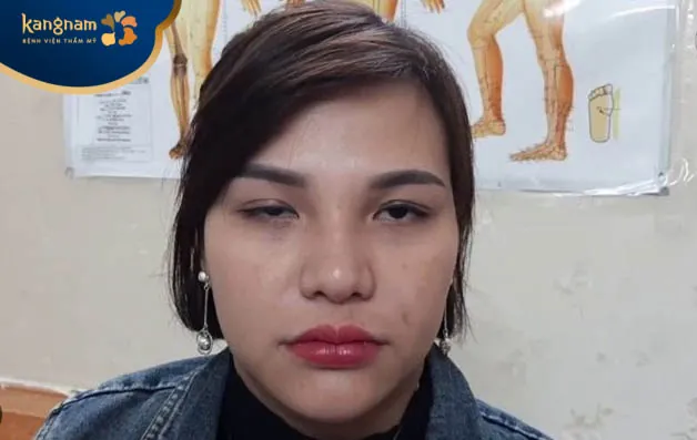 Thị lực bị ảnh hưởng sau tiêm botox không đảm bảo