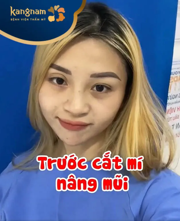 Bông Trần trước khi cắt mí, nâng mũi
