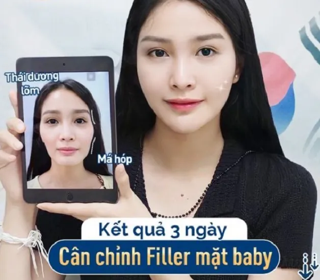 Chị Trang Linh khắc phục các khuyết điểm trên gương mặt nhờ tiêm filler