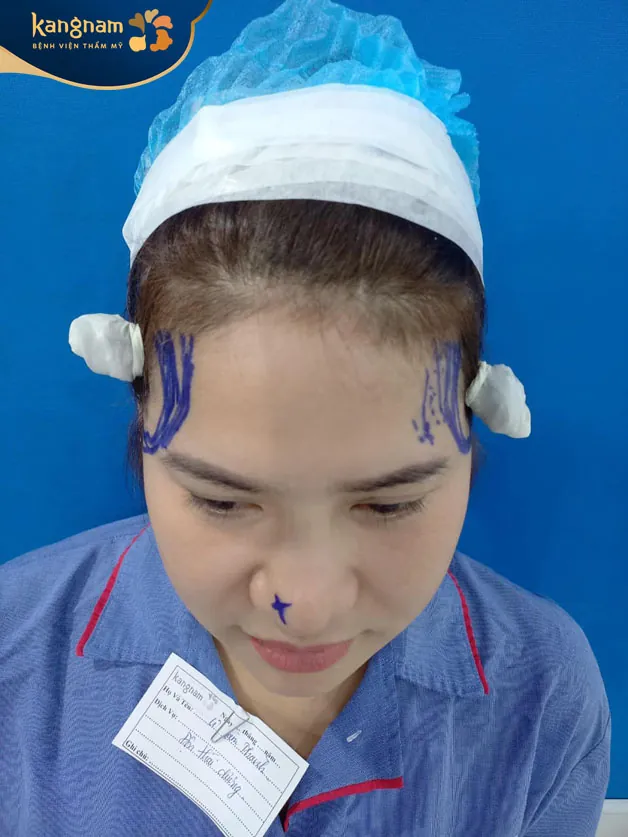 Đo vẽ, thiết kế vùng độn 2 bên thái dương