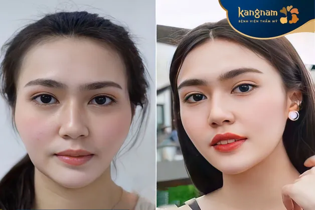 Độn thái dương tại Kangnam giúp gương mặt cân đối, hài hòa