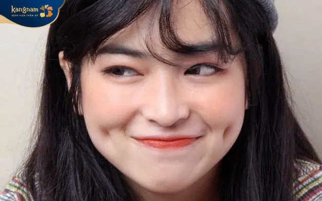 Có 4 dạng má lúm thường gặp