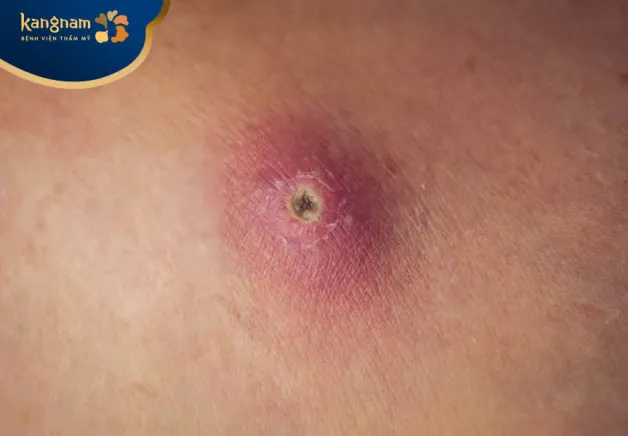 Nặn mụn đinh râu có bị méo mồm hay không?