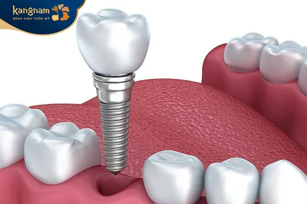 Ngăn chặn tiêu xương, tụt lợi