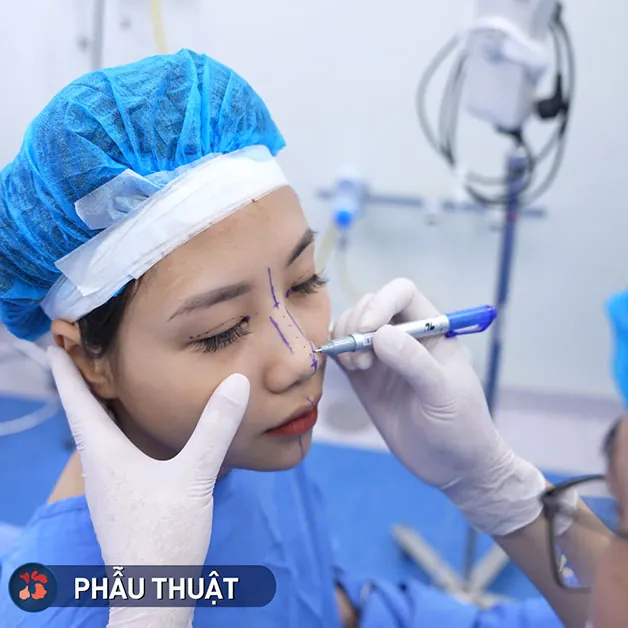 Trước và sau nâng mũi - Thanh Hoa Gen Z tại Kangnam
