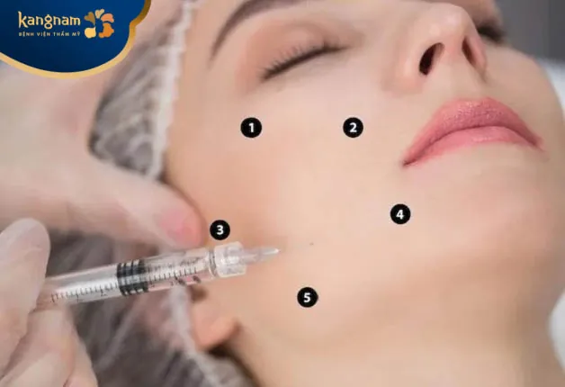 Tại sao lại có biểu hiện sưng sau tiêm profhilo?