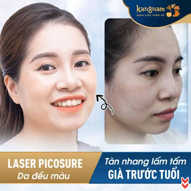Xóa tàn nhang lấm tấm, giúp khách hàng tươi trẻ, rạng rỡ hơn với làn da mịn màng