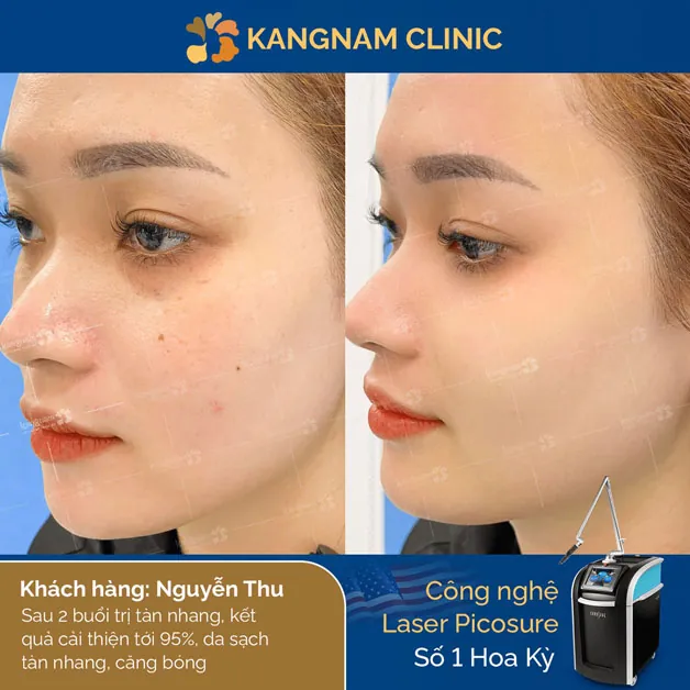 Bạn Nguyễn Thu hài lòng sau khi trị nám dưới bầu mắt, tăng thêm sự tự tin