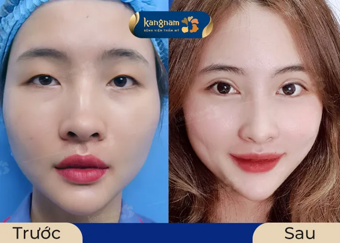 Đôi mắt long lanh, to tròn và cân đối sau khi mở góc mắt