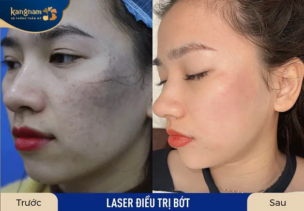 Da sáng, đều màu sau 1 liệu trình điều trị bớt