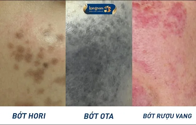 Bớt sắc tố trên da là một loại tổn thương lành tính, có thể xảy ra do tăng sinh tế bào sắc tố da
