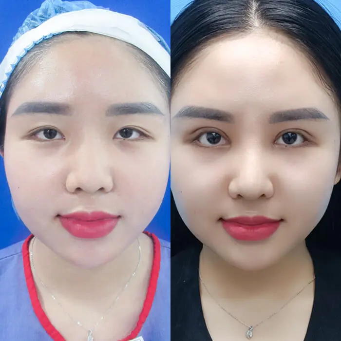 Sau khi cắt mí đôi mắt tinh anh và long lanh hơn