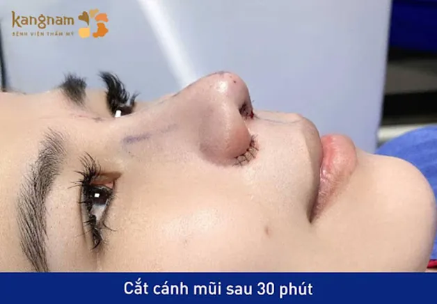 Cắt cánh mũi là sự lựa chọn lý tưởng đối với những người có cánh mũi dày