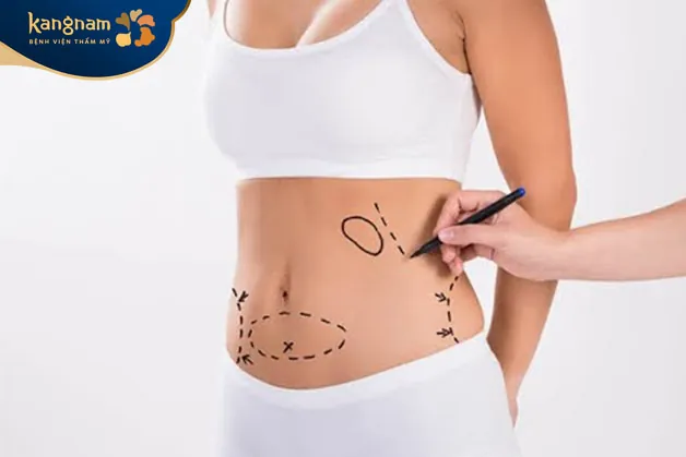 Bụng bị chùng nhão sau khi thực hiện hút mỡ có thể tạo hình thành bụng