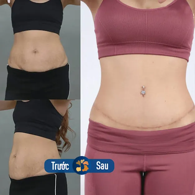 Vết sẹo được thực hiện tại nếp lằn bikini, không lo bị lộ sẹo