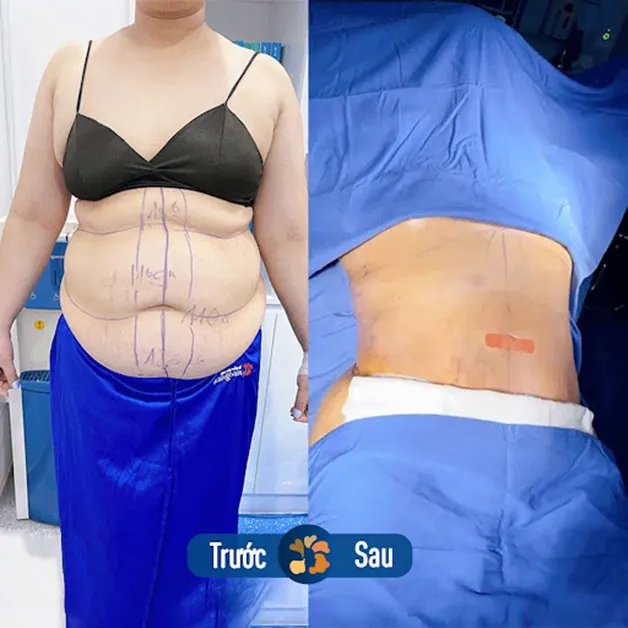 Giảm mỡ, loại bỏ da thừa, da chùng, giúp vòng 2 thon gọn