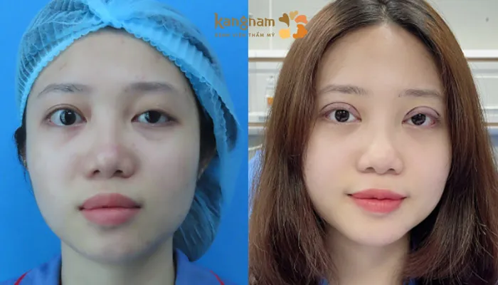 Treo cơ nâng mi chỉnh hình sụp mí phù hợp với trường hợp cơ nâng mi yếu